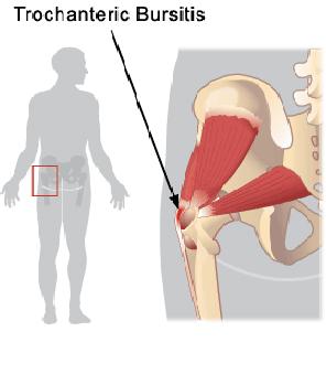 Trochanteric Bursitis.JPG